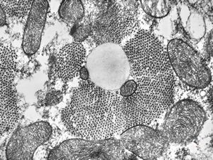 M,15y. | lipid droplet in cardiomyocyte … heart M,15y. | lipid droplet in cardiomyocyte … heart